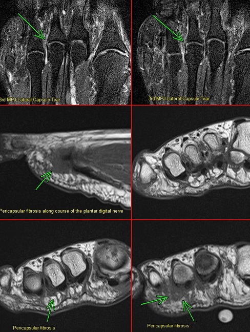 Figure 2 for case Tear MPJ plantar plate and lateral capsule